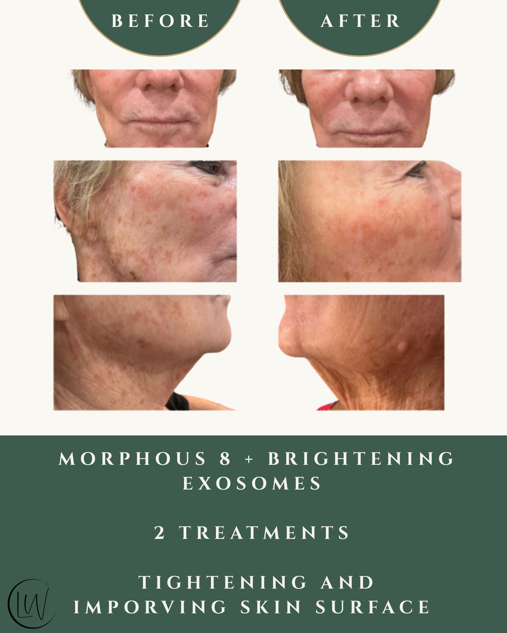 Lip filler before and after results