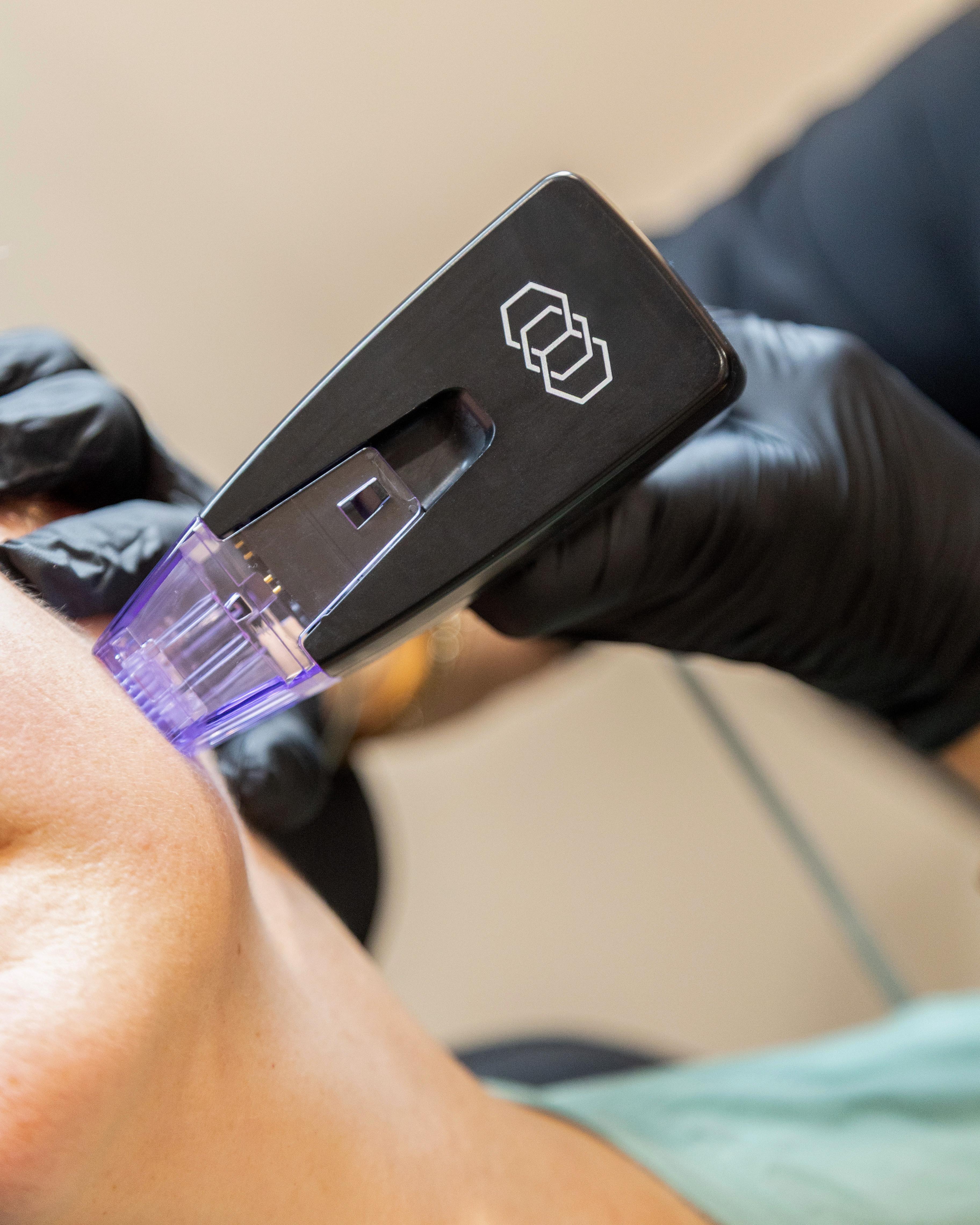 Morpheus8 Face Treatment