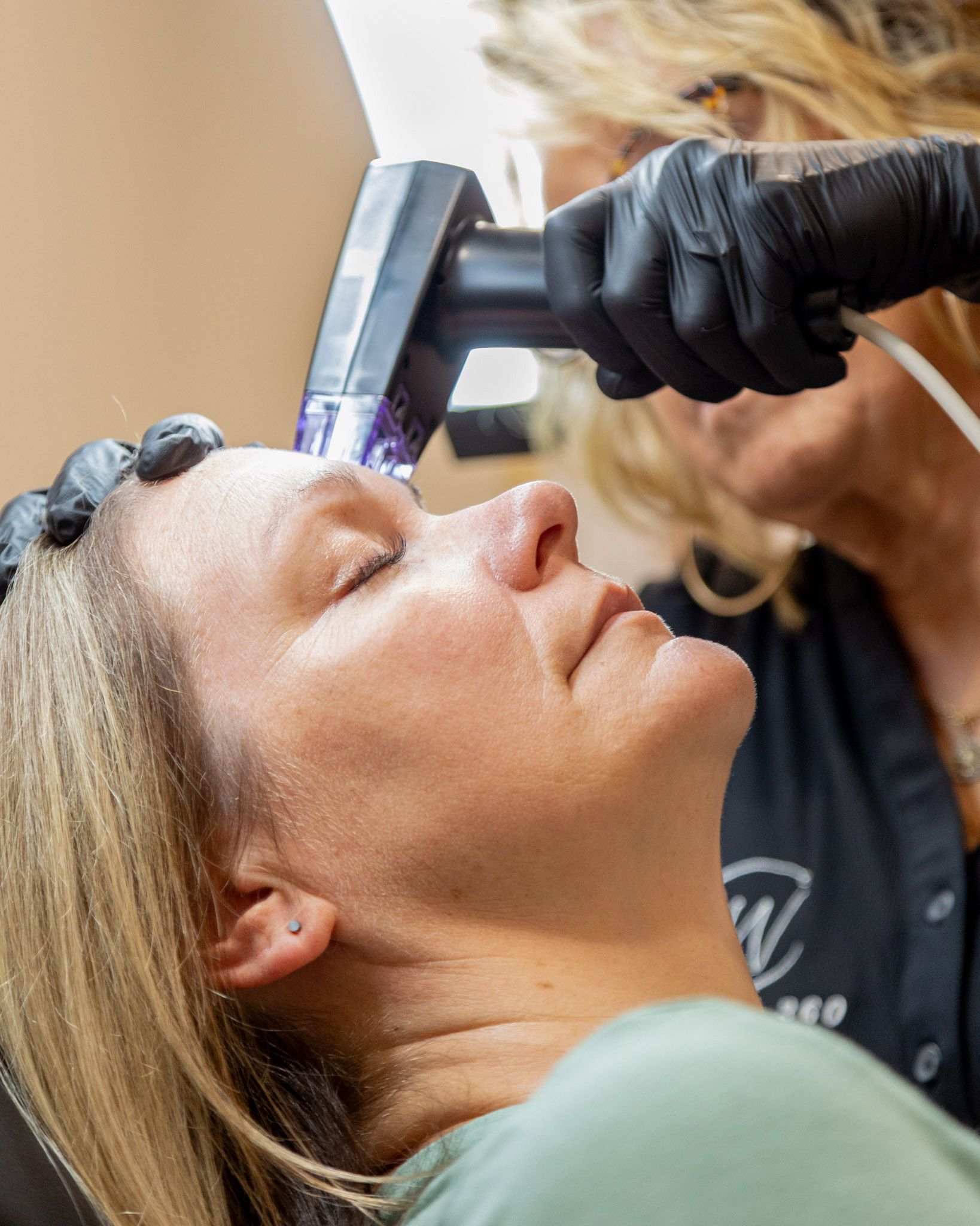 Morpheus8 Face Treatment