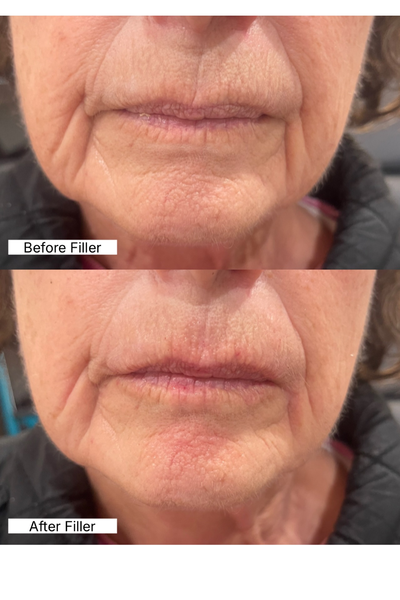 Before and after — Dermal filler — lower face and smile lines, at Live Well 360 in Kokomo, Indiana