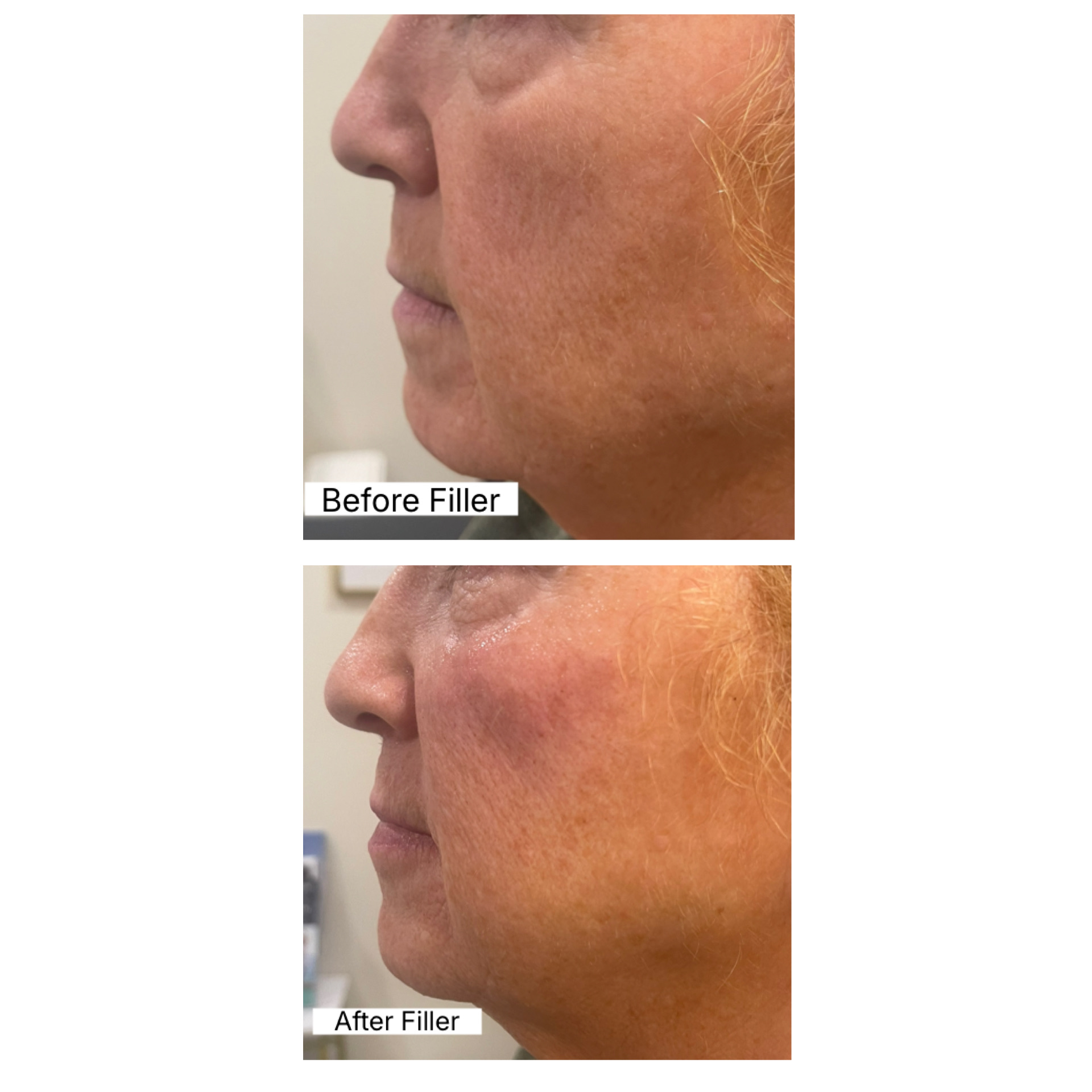 Before and after — Dermal filler — cheek and midface, at Live Well 360 in Kokomo, Indiana