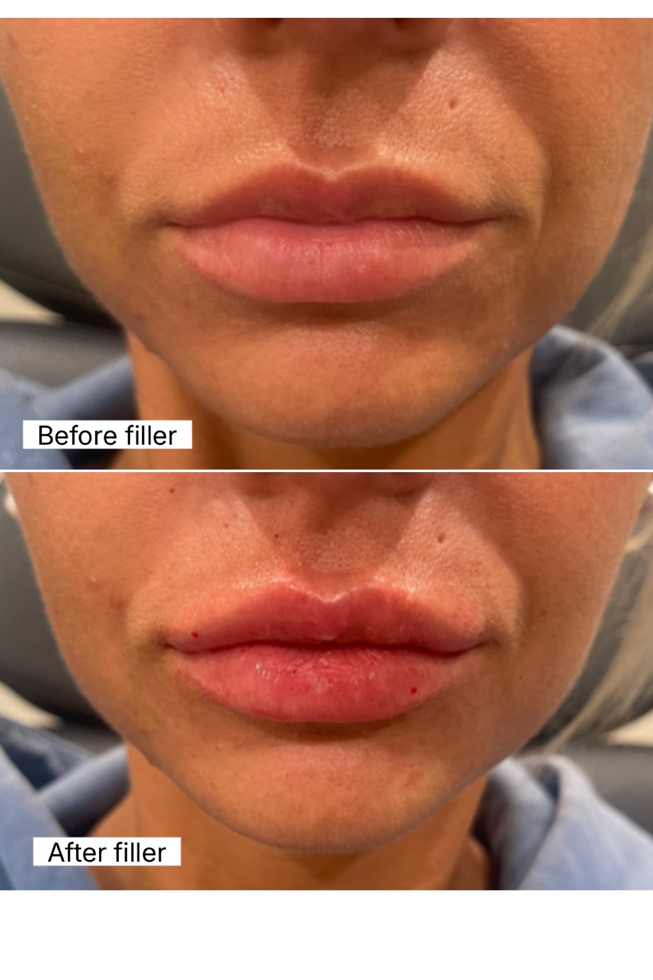 Before and after — Lip filler — before and after, at Live Well 360 in Kokomo, Indiana