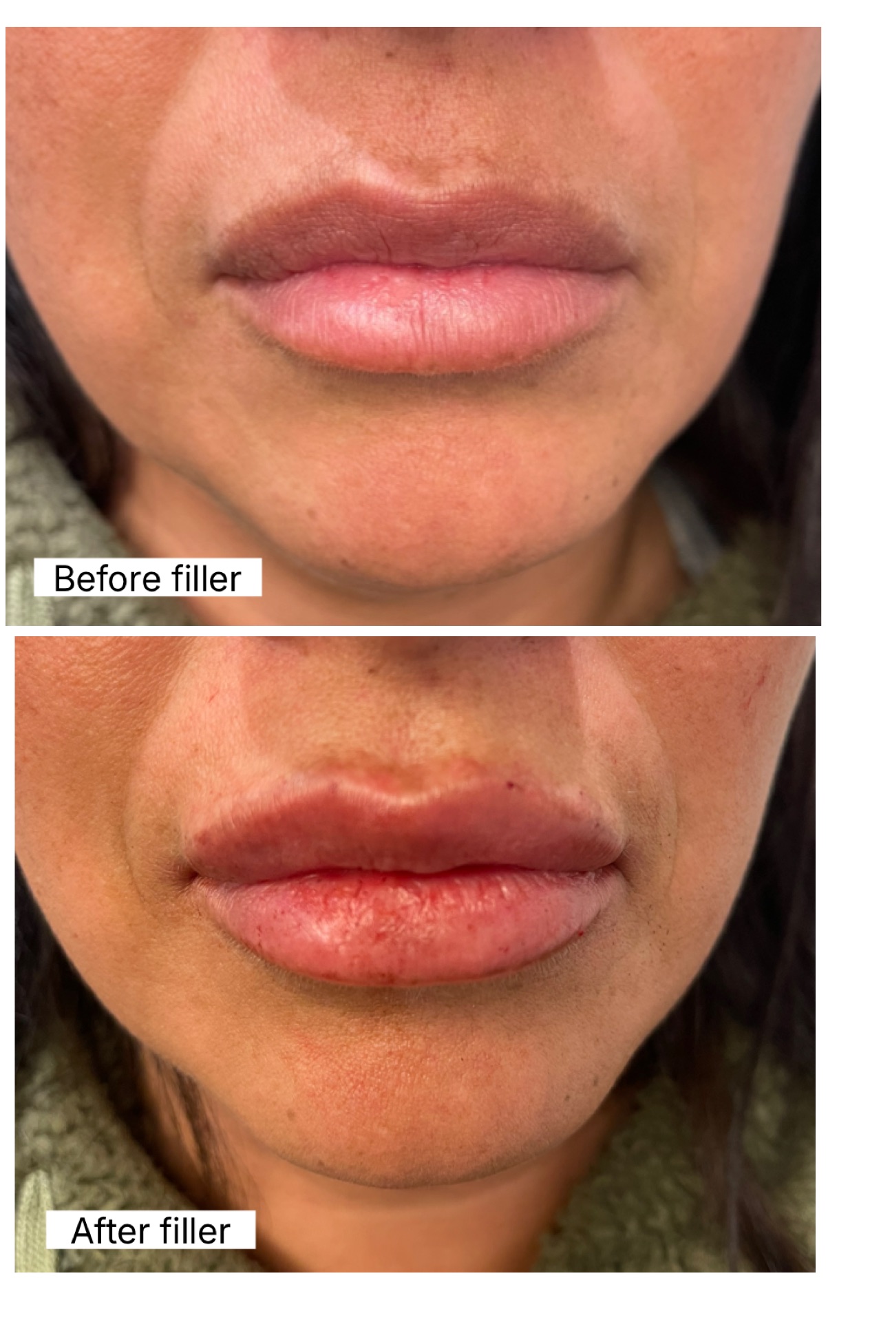 Before and after — Lip filler — before and after, at Live Well 360 in Kokomo, Indiana
