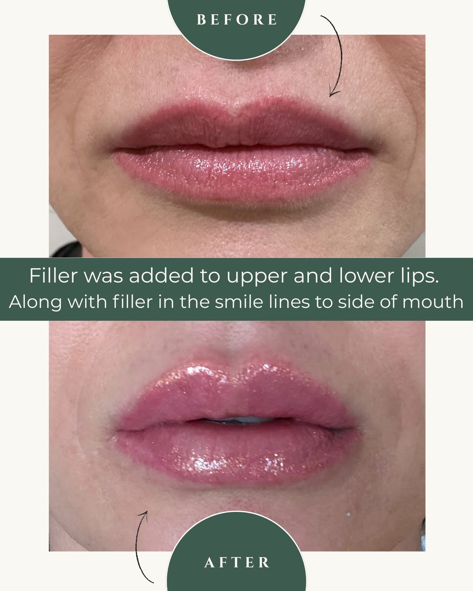 Before and after — Filler to the upper and lower lips, plus the smile lines, at Live Well 360 in Kokomo, Indiana
