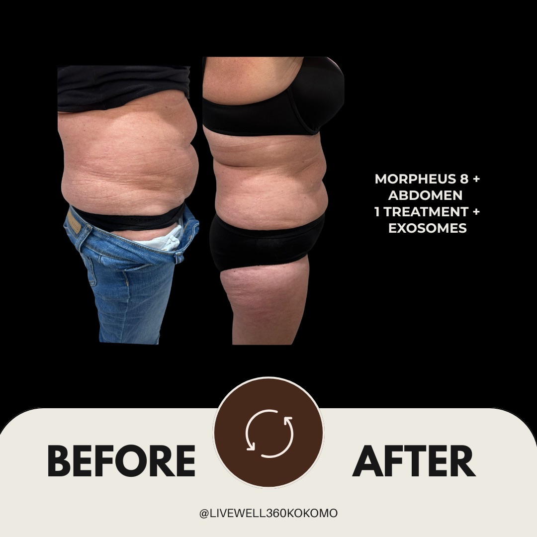 Before and after — Morpheus8 with exosomes, abdomen — 1 treatment, at Live Well 360 in Kokomo, Indiana