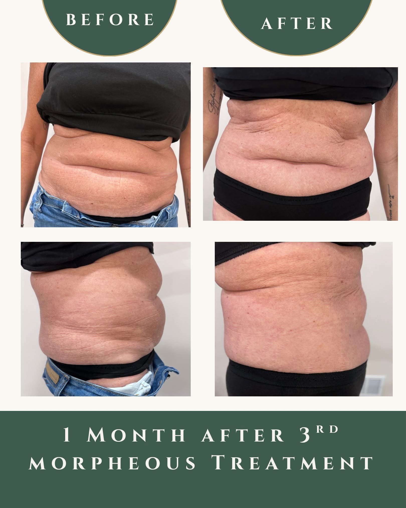 Before and after — Abdomen — 1 month after a third Morpheus8 treatment, at Live Well 360 in Kokomo, Indiana