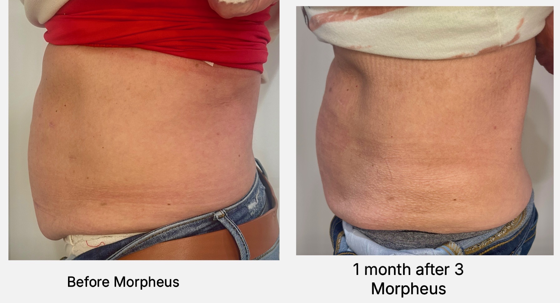 Before and after — Flank and waist — 1 month after three Morpheus8 treatments, at Live Well 360 in Kokomo, Indiana
