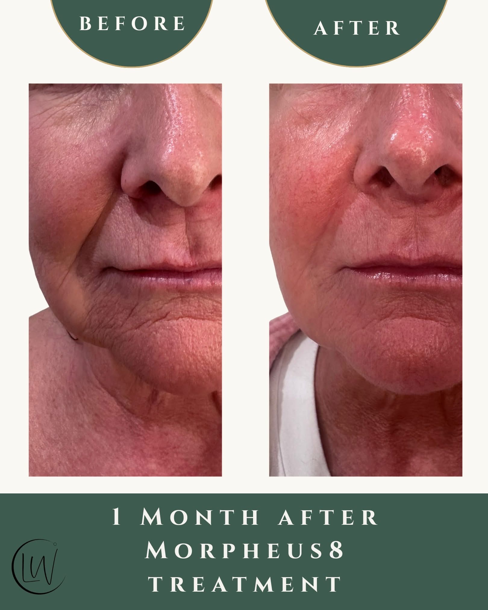 Before and after — Morpheus8 — 1 month after treatment, at Live Well 360 in Kokomo, Indiana