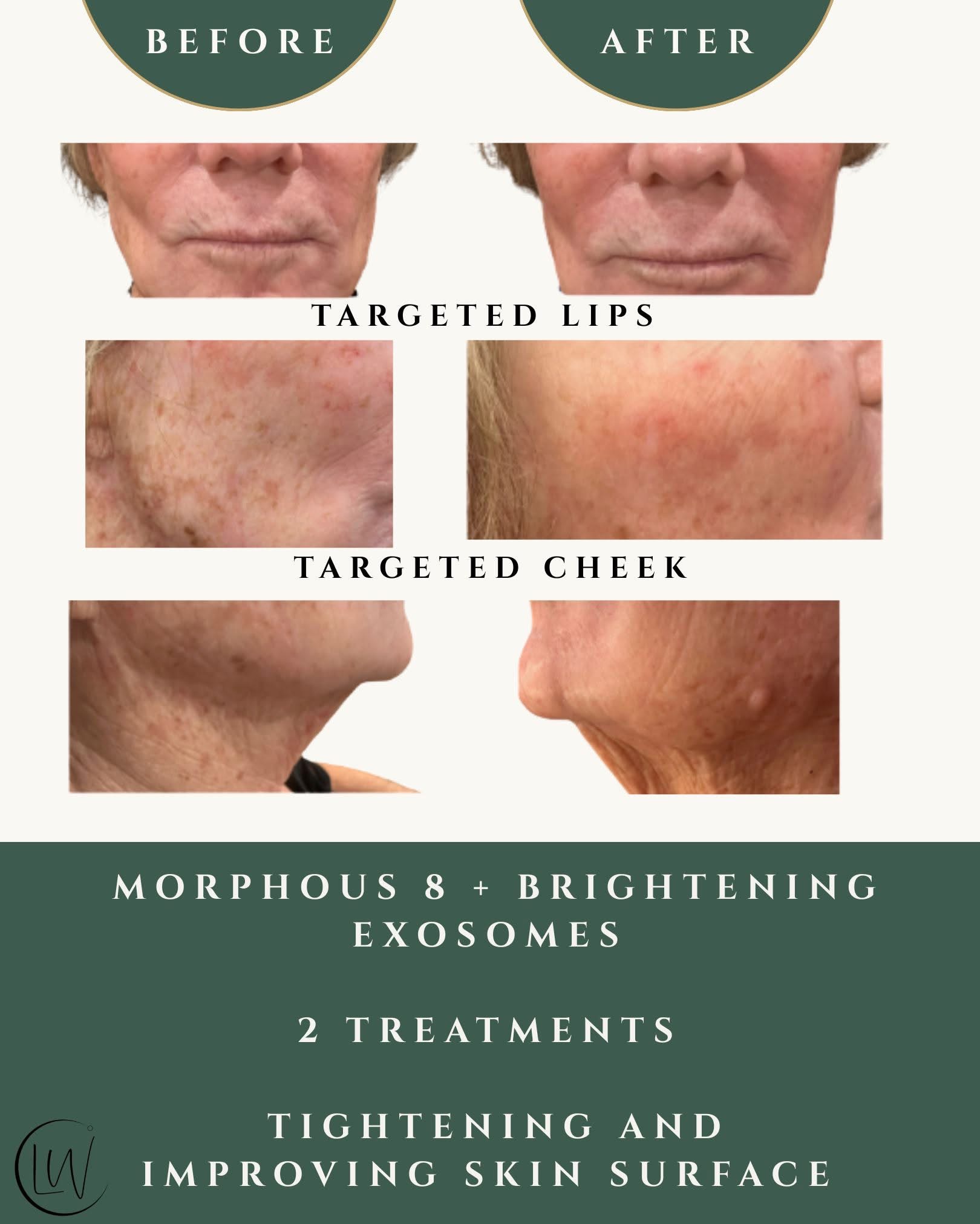 Before and after — Morpheus8 with brightening exosomes — 2 treatments, lips and cheek, at Live Well 360 in Kokomo, Indiana