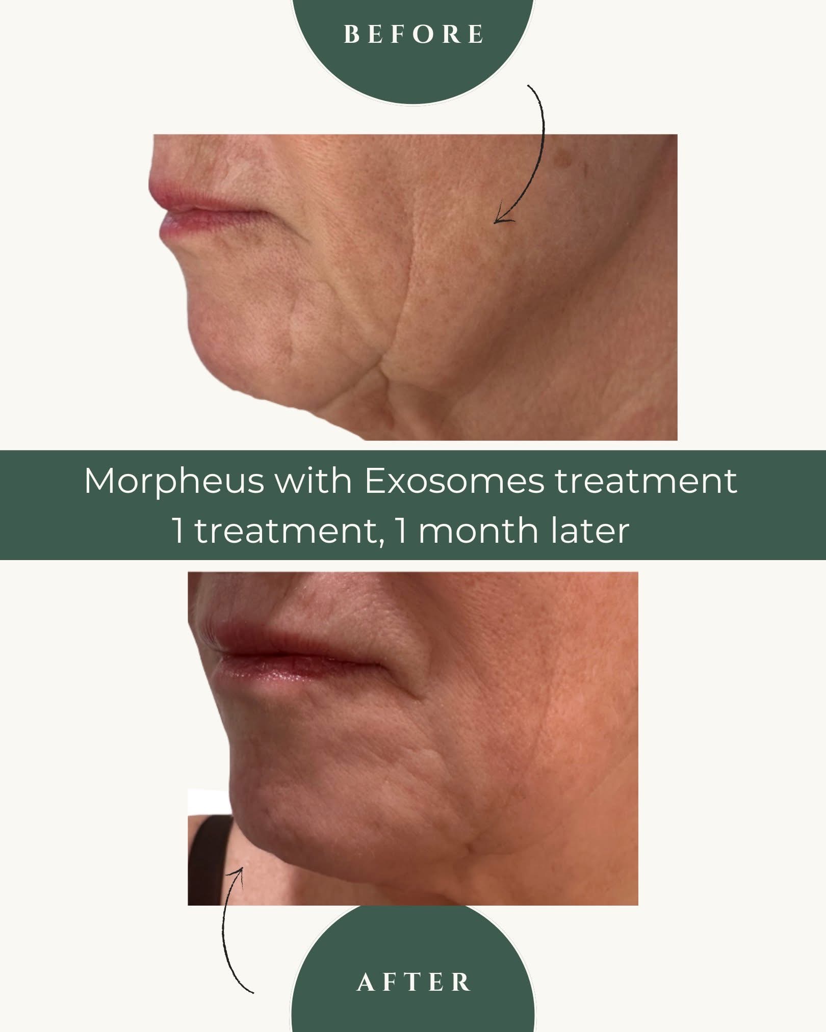 Before and after — Morpheus8 with exosomes — 1 treatment, 1 month later, at Live Well 360 in Kokomo, Indiana