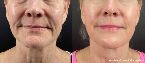 Before and after — Morpheus8 — full face and jawline, at Live Well 360 in Kokomo, Indiana