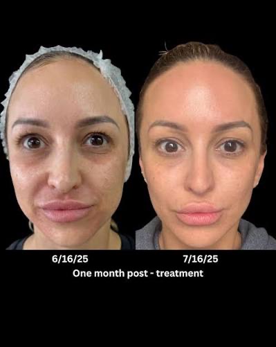 Before and after — One month post-treatment, at Live Well 360 in Kokomo, Indiana