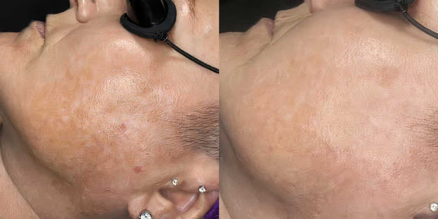 Before and after — Jawline and neck texture, at Live Well 360 in Kokomo, Indiana