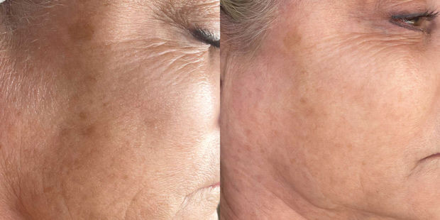 Before and after — Cheek and under-eye texture, at Live Well 360 in Kokomo, Indiana